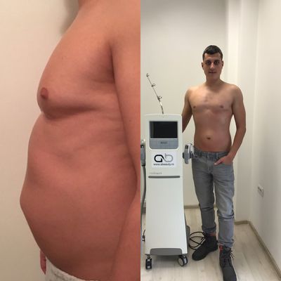 Gabriel Ursan Before After