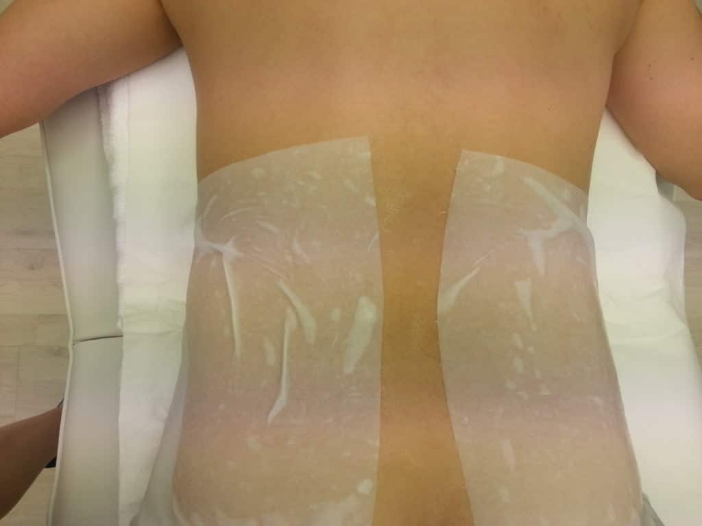 Criolipoliza 1