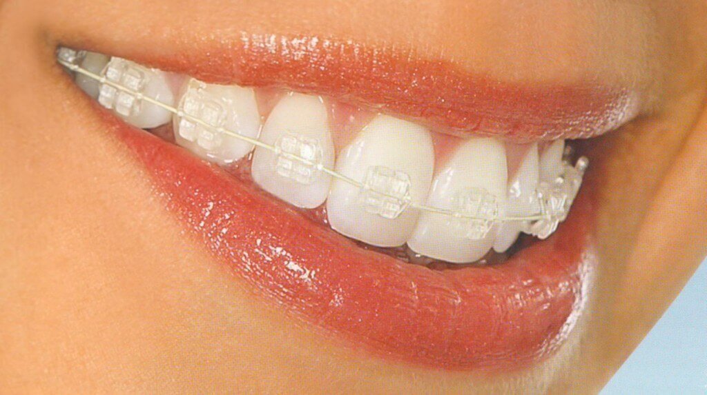 Aparat dentar Safir
