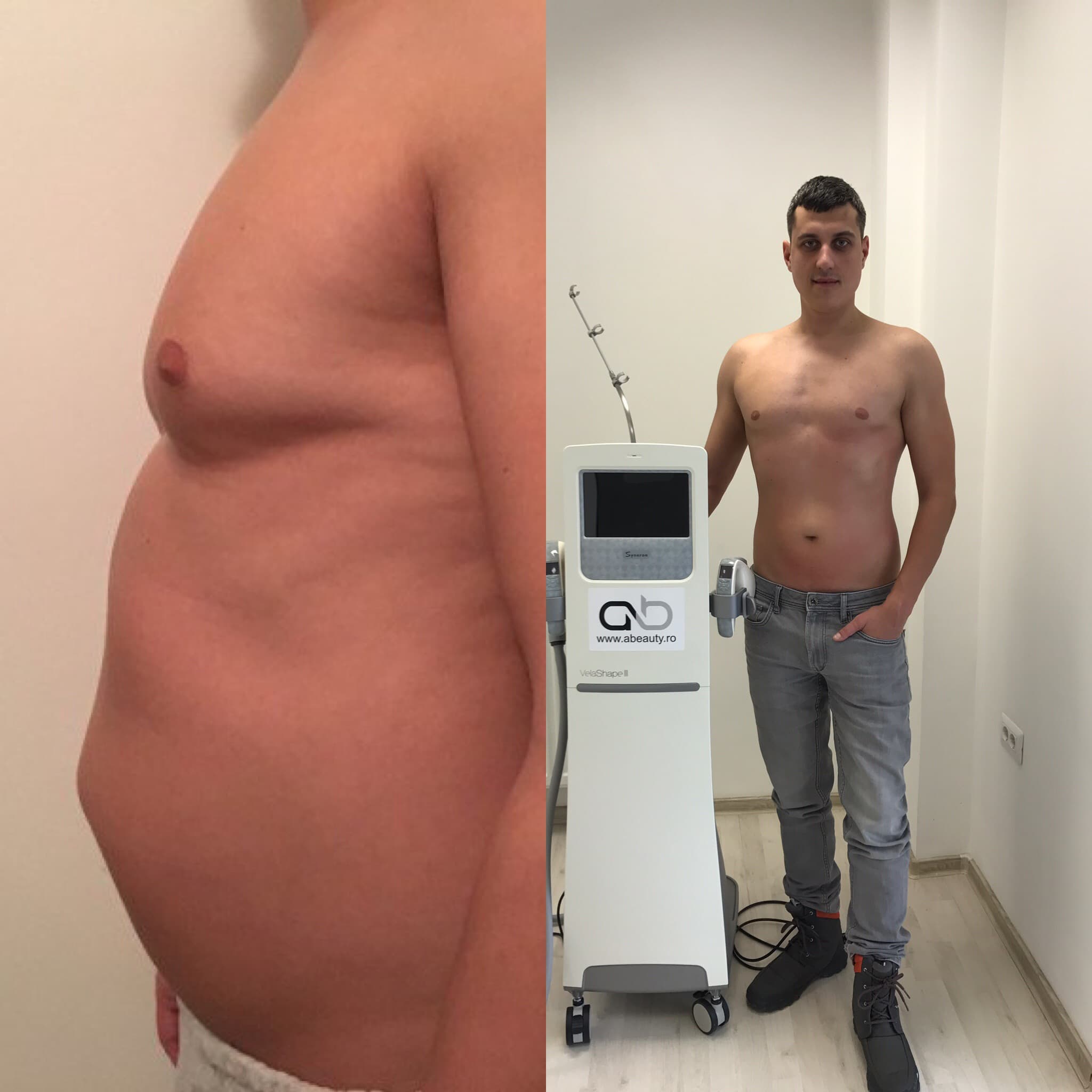 Gabriel Ursan Before After